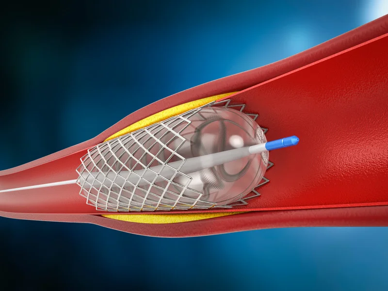 Read more about the article Understanding Angioplasty: A Comprehensive Guide