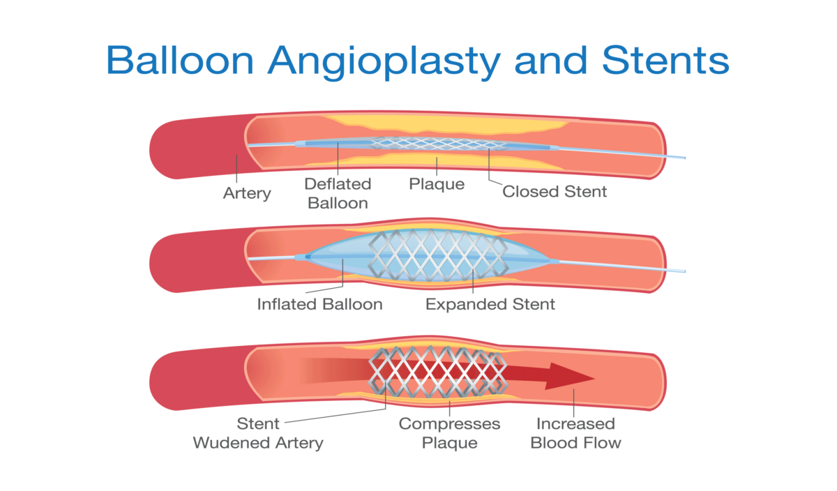 Read more about the article Understanding CAD Treatments: Angioplasty and Stents Explained