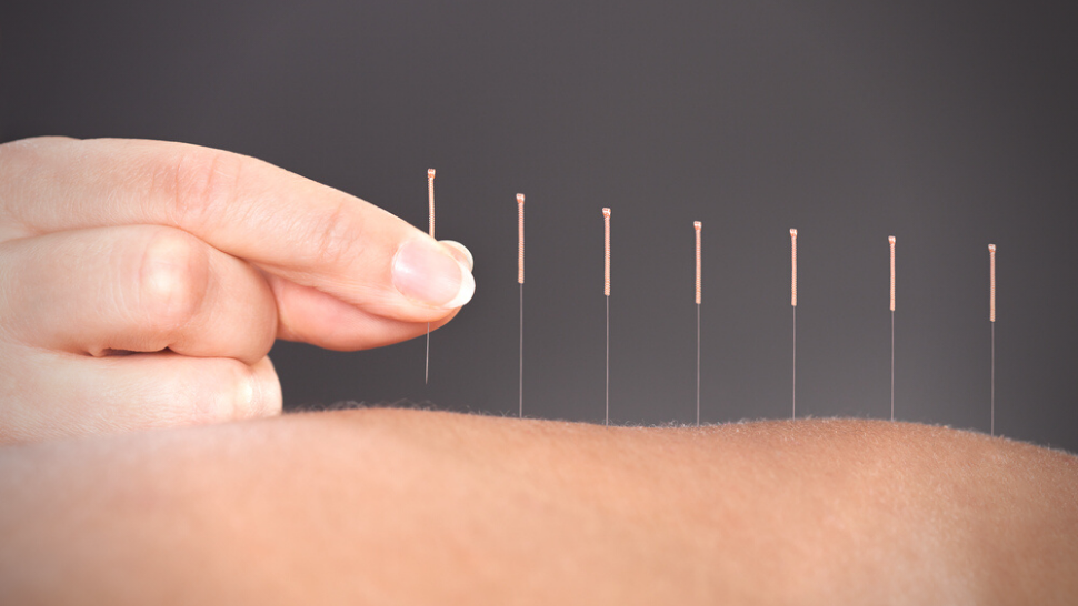 Read more about the article Affordable Acupuncture in HK: Best Clinics & Tips