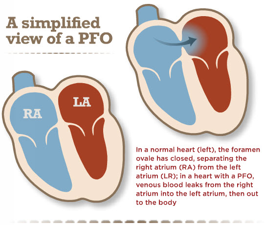 Understanding the Risks of a ‘Hole’ in the Heart: PFO and Stroke