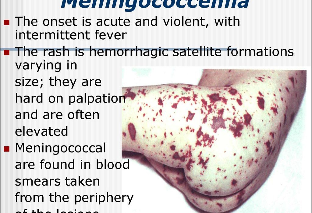 CHP Reports Meningococcal Infection Case: Key Facts