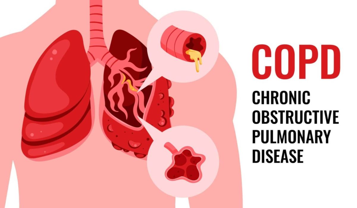 COPD: Causes, Risks & Prevention Tips for Healthy Lungs