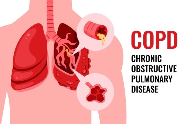 COPD: Causes, Risks & Prevention Tips for Healthy Lungs
