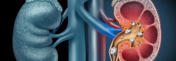 How to relieve kidney stone pain fast in Hong Kong