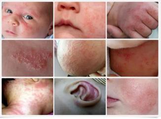 Summer Itchy Skin in Children: Eczema or Atopic Dermatitis?